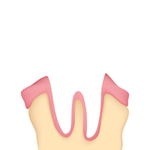 perda de dentes